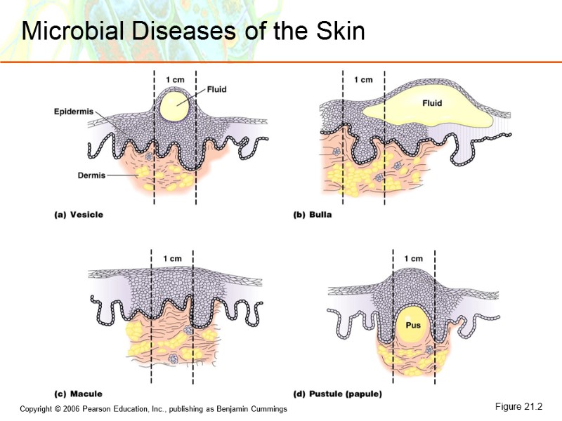 Microbial Diseases of the Skin Figure 21.2